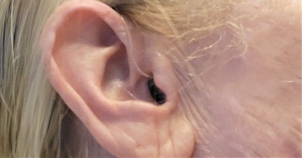 Innovative Horizons: Understanding Advanced Solutions for Conductive Hearing Loss